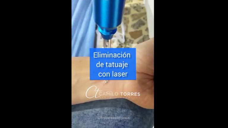 Borrar tatuajes - Dr. Camilo Rafael Torres Rodríguez
