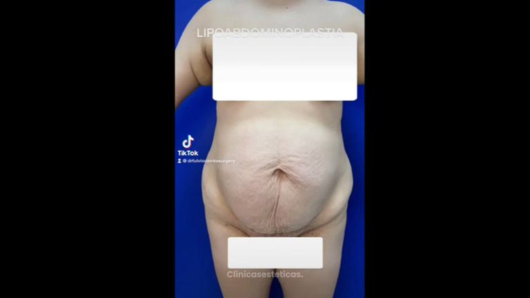 Abdominoplastia - Dr Fulvio Alexander Correa