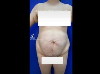 Abdominoplastia - Dr Fulvio Alexander Correa