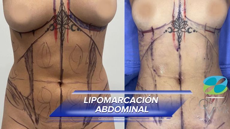 Liposucción - Clínica Vivir