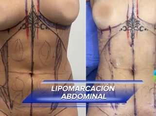 Liposucción - Clínica Vivir