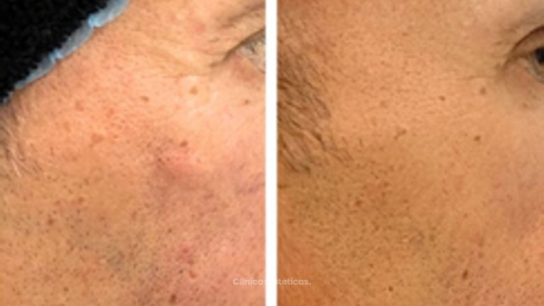 Bioestimuladores - Doctora Alexandra Mora