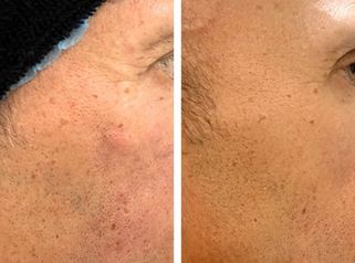 Bioestimuladores - Doctora Alexandra Mora