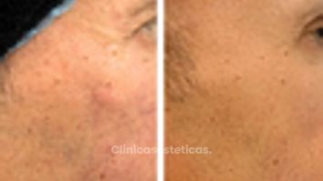 Bioestimuladores - Doctora Alexandra Mora