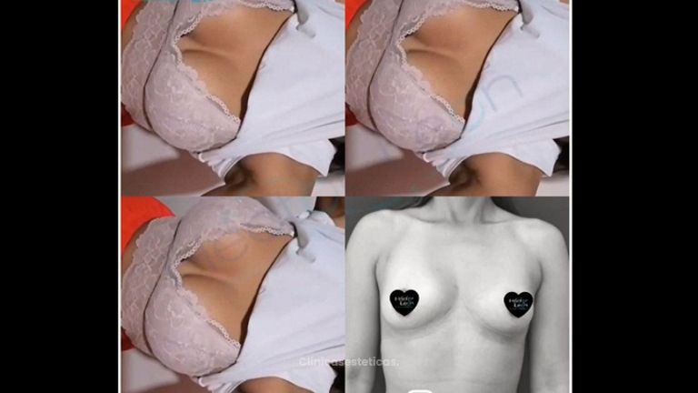Mamoplastia de aumento - Dr. Héctor Guillermo León Higuera
