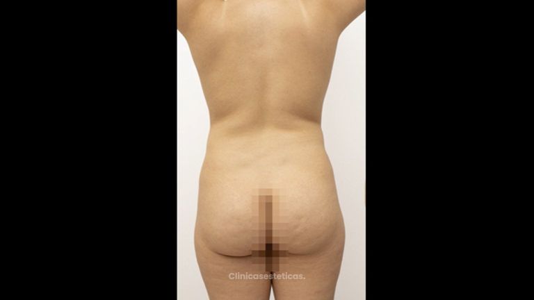 Lipoescultura - Dr. Luis Fernando Reyes & Dra. Nicole Echeverry