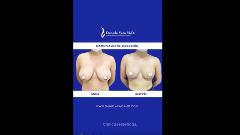 Mamoplastia de reducción - Dra. Daniela Stephania Vaca Grisales