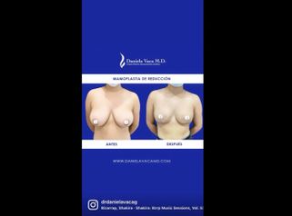 Mamoplastia de reducción - Dra. Daniela Stephania Vaca Grisales