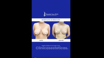 Mamoplastia de reducción - Dra. Daniela Stephania Vaca Grisales
