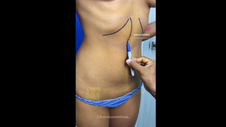 Liposucción - Dr Fulvio Alexander Correa