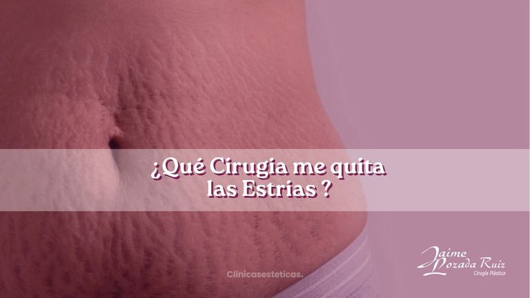 Que Cirugía me quita las estrias? - Dr. Jaime Lozada Ruiz