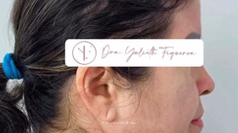 Lipopapada + Endolift  tercio inferior - Dra. Yulieth Figueroa Peñaranda