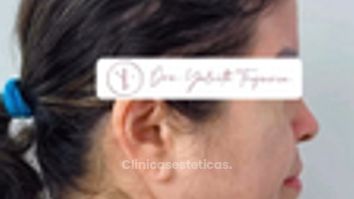 Lipopapada + Endolift  tercio inferior - Dra. Yulieth Figueroa Peñaranda