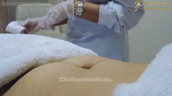 Intradermoterapia - Dr. Juan Carlos Herrera P.