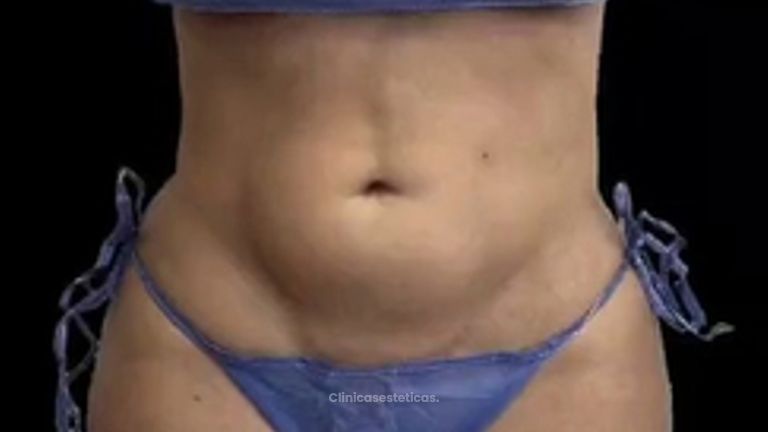 Lipoescultura - Dra. Ángeles Esmeral