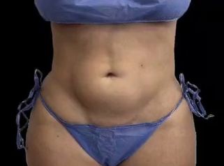 Lipoescultura - Dra. Ángeles Esmeral
