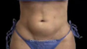 Lipoescultura - Dra. Ángeles Esmeral