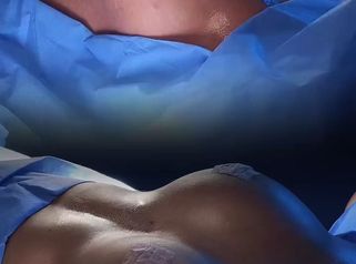 Mamoplastia de aumento