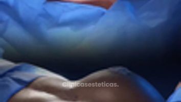 Mamoplastia de aumento