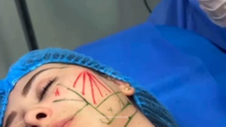 Endolaser corporal, endolifing facial - Dra. Carmen Padilla