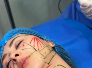 Endolaser corporal, endolifing facial - Dra. Carmen Padilla