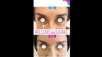 Eliminar ojeras - Doctora Alexandra Mora