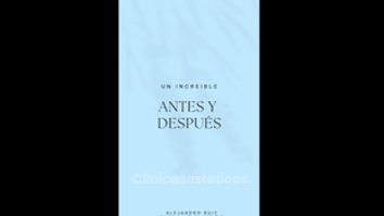 Liposucción - Dr. Alejandro Ruiz Cortés