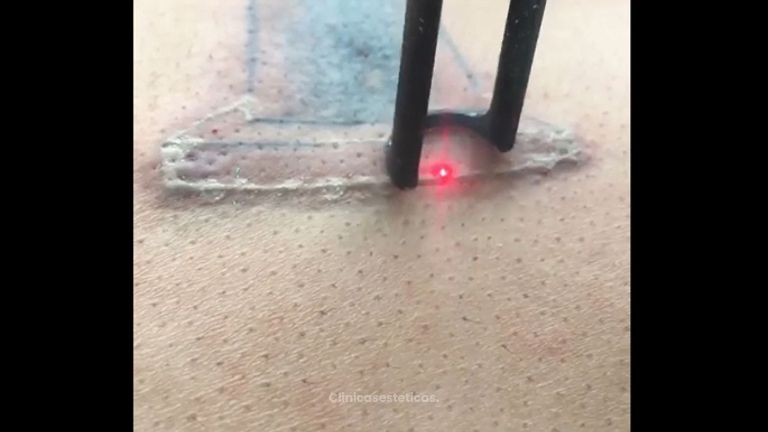Borrar tatuajes - Innova Laser Center