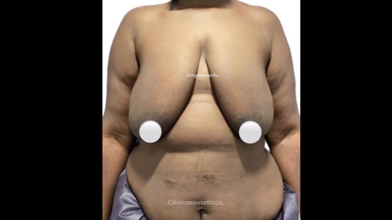 Mamoplastia de recucción - Dr. Felipe Galiano