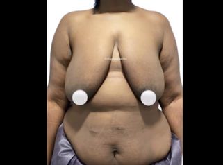 Mamoplastia de recucción - Dr. Felipe Galiano