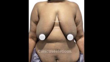 Mamoplastia de recucción - Dr. Felipe Galiano