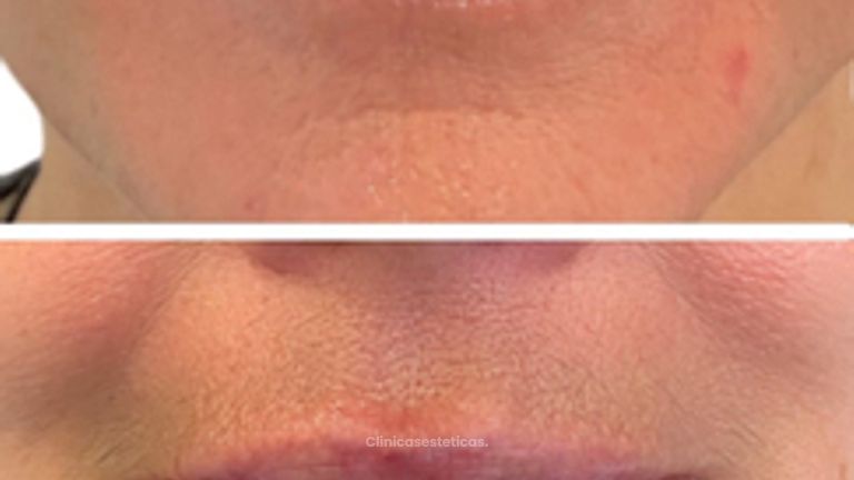 Relleno de labios - Doctora Alexandra Mora