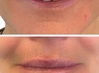 Relleno de labios - Doctora Alexandra Mora