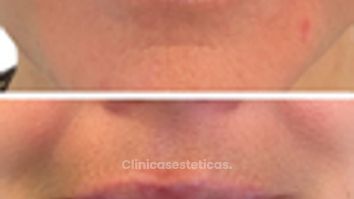 Relleno de labios - Doctora Alexandra Mora
