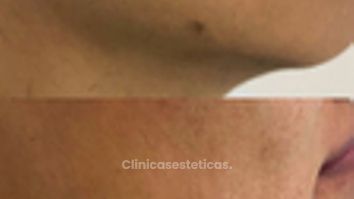 Remonición de Lesiones Benignas - Doctora Alexandra Mora