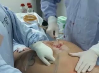 Acaba con la grasa sobrante con la tecnología láser