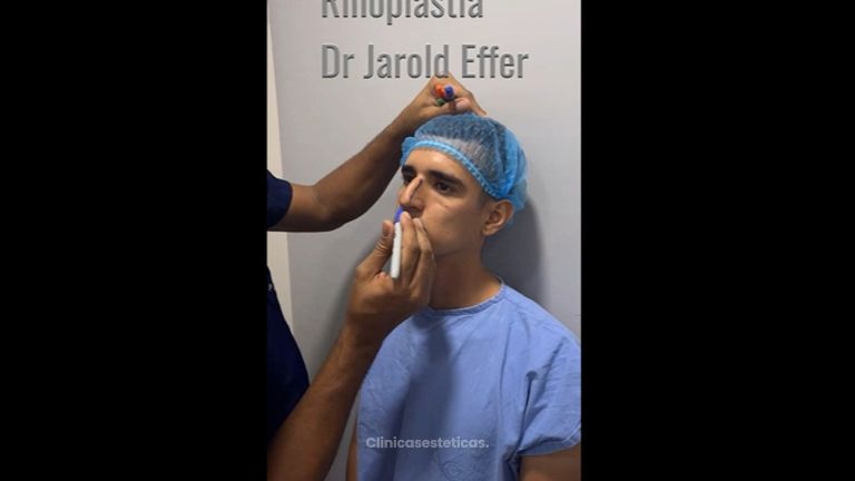 Rinoplastia - Dr. Jarold Effer Taylor