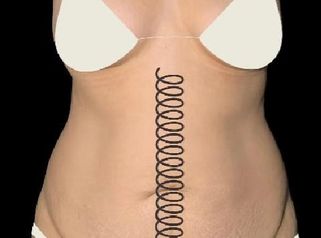 Abdominoplastia - Dr. Juan Canencio