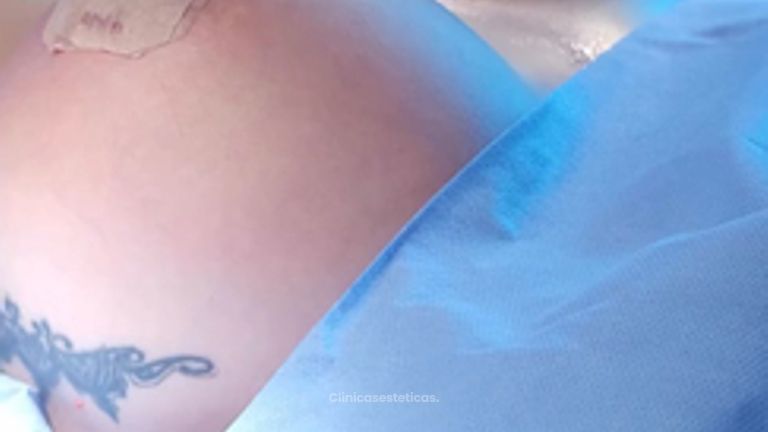 Mamoplastia de aumento - Clinica Vivir