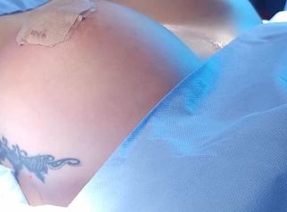Mamoplastia de aumento - Clinica Vivir