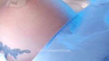 Mamoplastia de aumento - Clinica Vivir