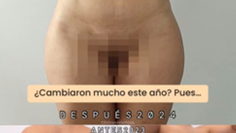 Lipoescultura - Dra. Nicole Echeverry