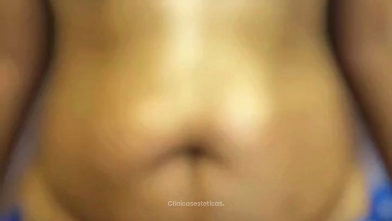 Abdominoplastia - Dra. Ángeles Esmeral