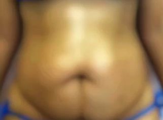 Abdominoplastia - Dra. Ángeles Esmeral