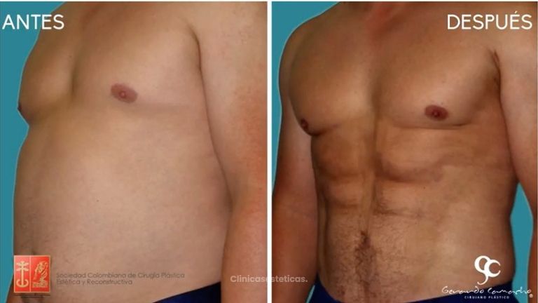 Definición Abdominal Masculina Colombia o Lipoescultura alta Definición Hombres Bogotá