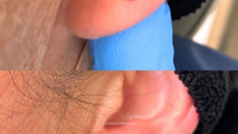 Lobuloplastia - Doctora Alexandra Mora