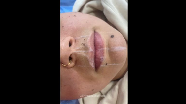 Aumento de labios - Dra. Luz María Cañavera