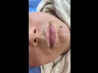 Aumento de labios - Dra. Luz María Cañavera