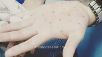 Hiperhidrosis palmar. Exceso de sudoración en las manos.