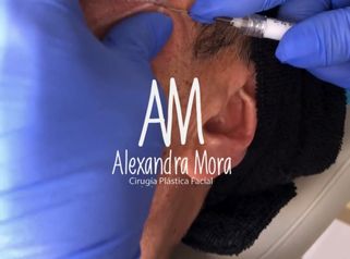 Aplicación de bioestimuladores - Doctora Alexandra Mora